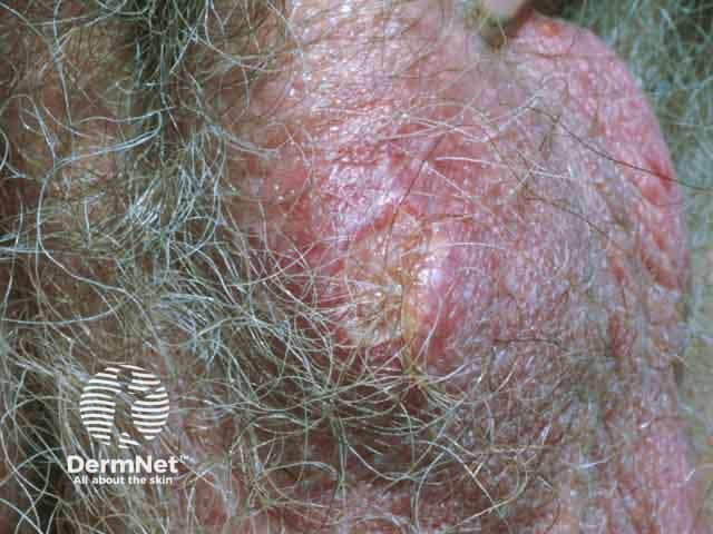 Scrotal aphthous ulcer in Behcet disease