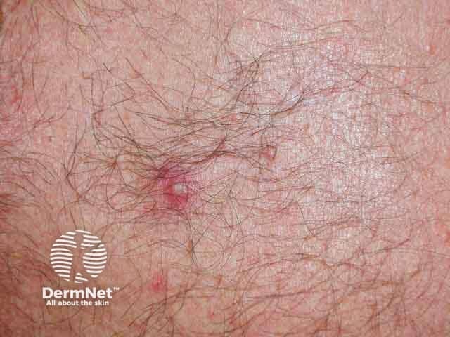 Pustular lesion in Behcet disease