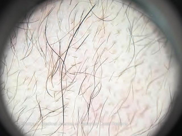 Short kinked hairs due to pili torti in Bjornstad syndrome