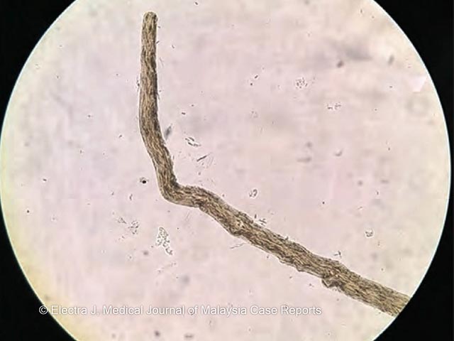 Tortuous kinked hairs in Bjornstad syndrome
