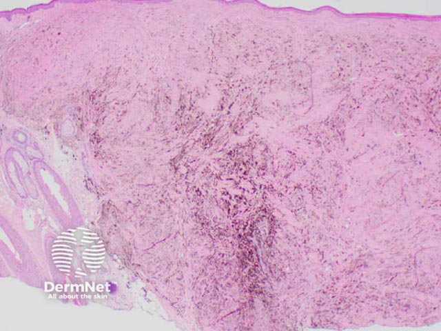 Proliferatin of heavily pigmented dendritic melanocytes in the dermis
