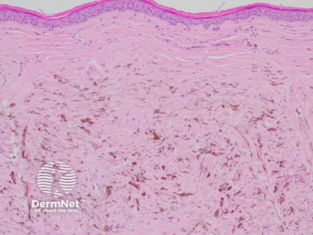 Proliferatin of heavily pigmented dendritic melanocytes in the dermis