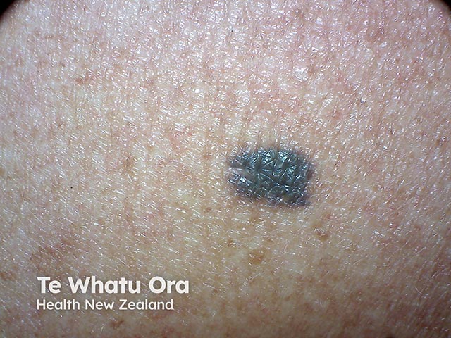 Clinical image of a blue naevus on the upper arm