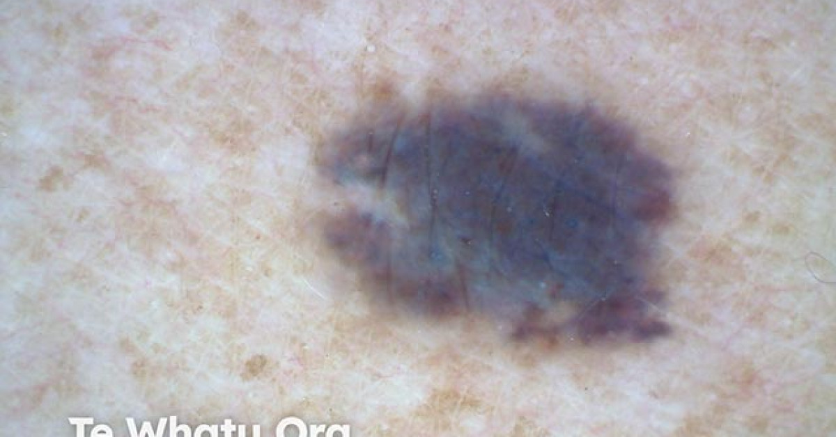 Blue naevus image
