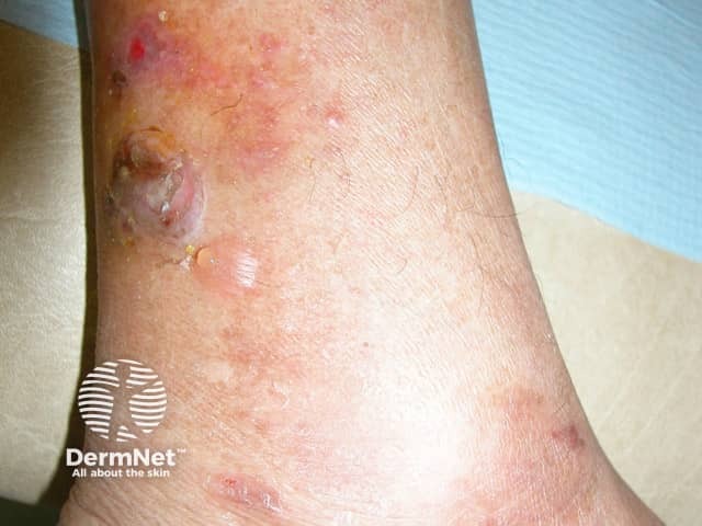 The blisters in this patient are due to bullosis diabeticorum; coma was due to hyperglycaemia