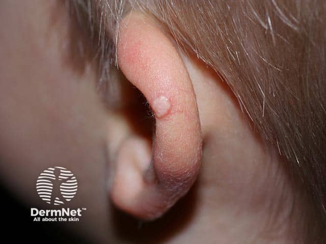 A subepidermal calcified nodule on the ear - note the typical chalky appearence