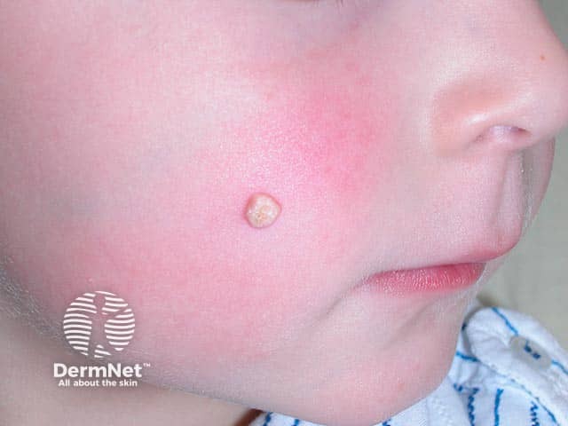 A subepidermal calcified nodule on the cheek - cheeks and ears are the most frequent location