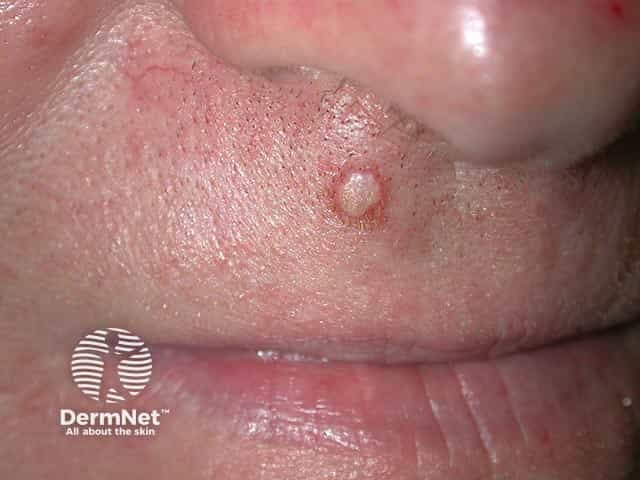 A subepidermal calcified nodule on the lip of an adult - they are more common in children