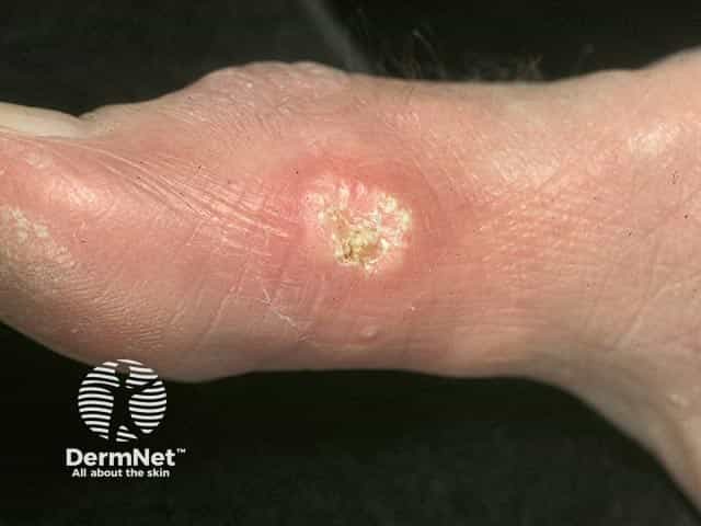 Idiopathic cutaneous calcification on the side of the foot