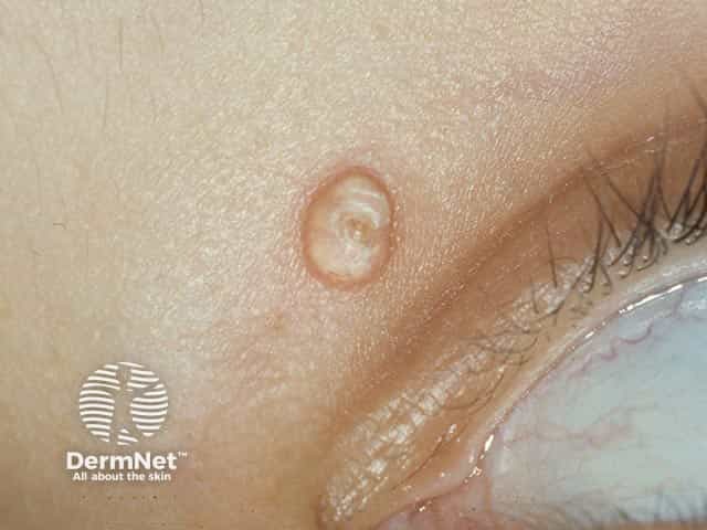 A subepidermal calcified nodule on the lid 