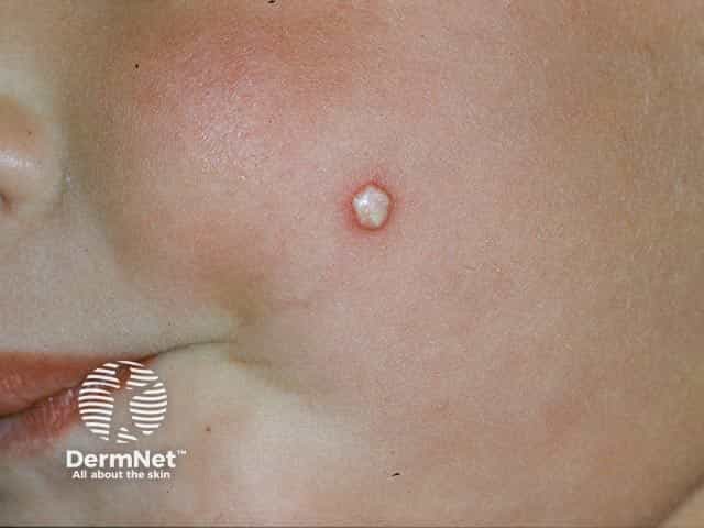 The typical chalky white appearence of a supepidermal calcified nodule on the cheek