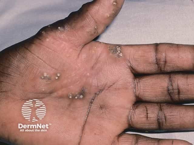 Multiple lesions of calcinosis cutis on the palm