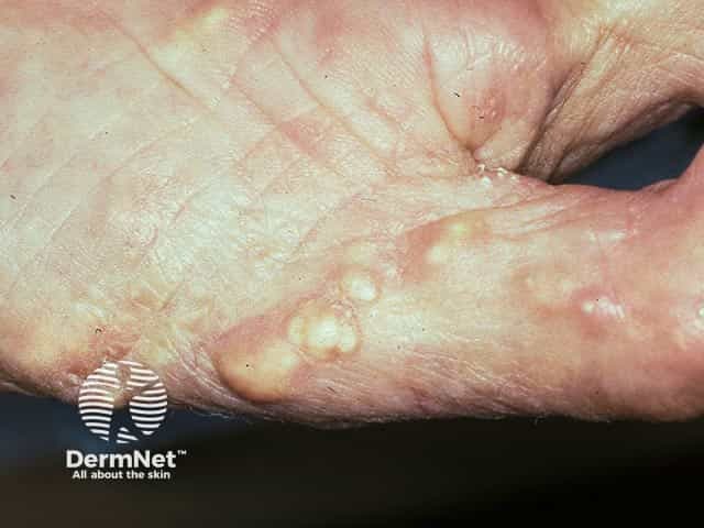Calcinosis cutis on the thumb - most commonly seen in CREST syndrome