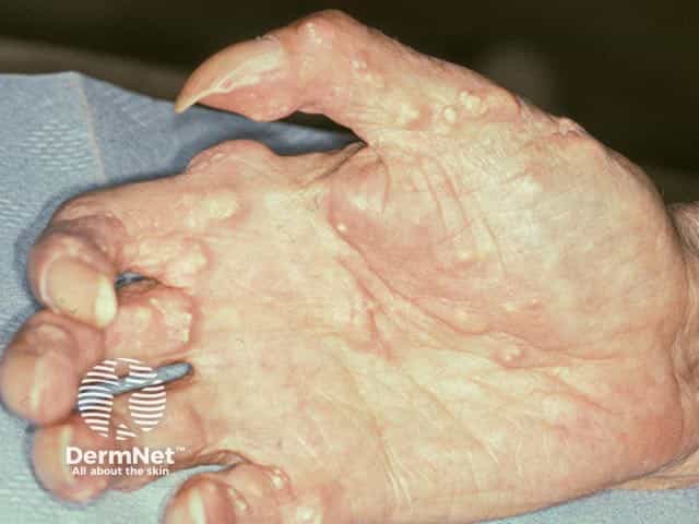 Calcinosis cutis on the fingers - most commonly seen in CREST syndrome