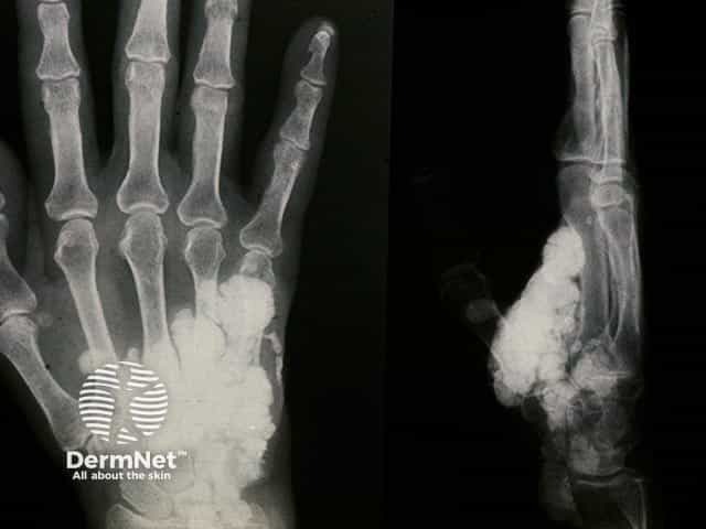 Radiograph of the hand in extensive calcinosis cutis showing palmar calcification