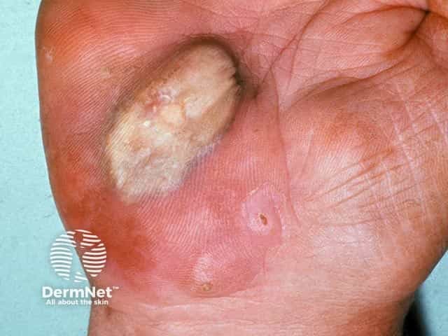 A large area of calcinosis cutis on the heel of the palm