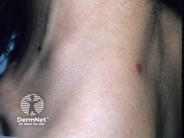 The primary lesion of cat scratch disease on the neck