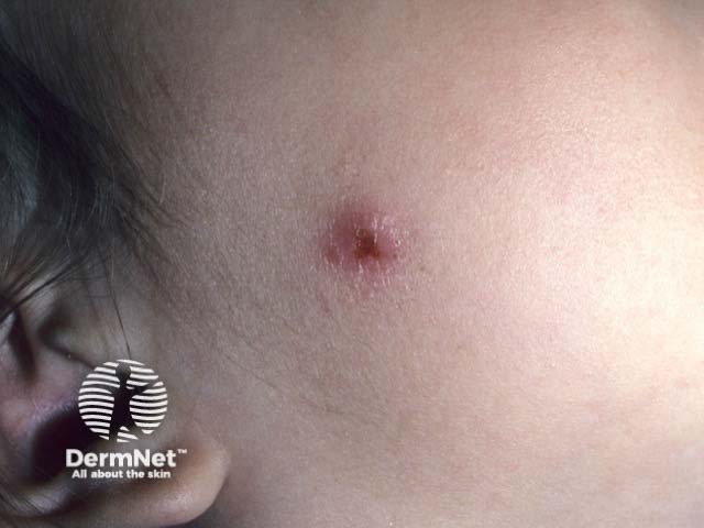 A primary lesion of cat scratch disease on the cheek