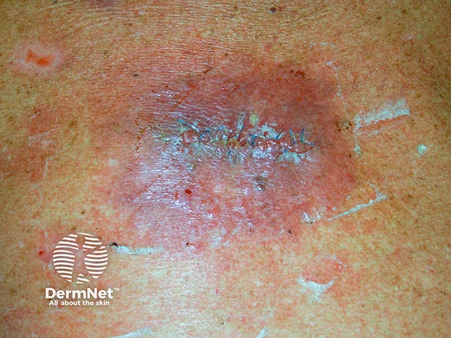 Manuka honey used to treat cellulitis developing post surgical excision