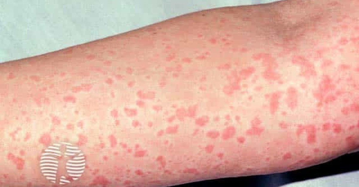 Cholinergic Urticaria Image