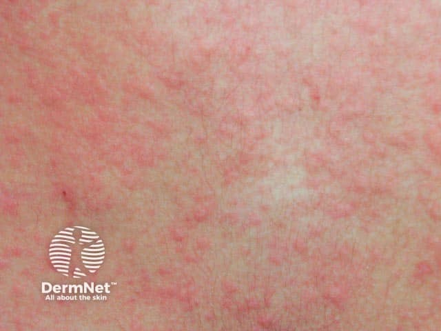 Cholinergic Urticaria Images DermNet