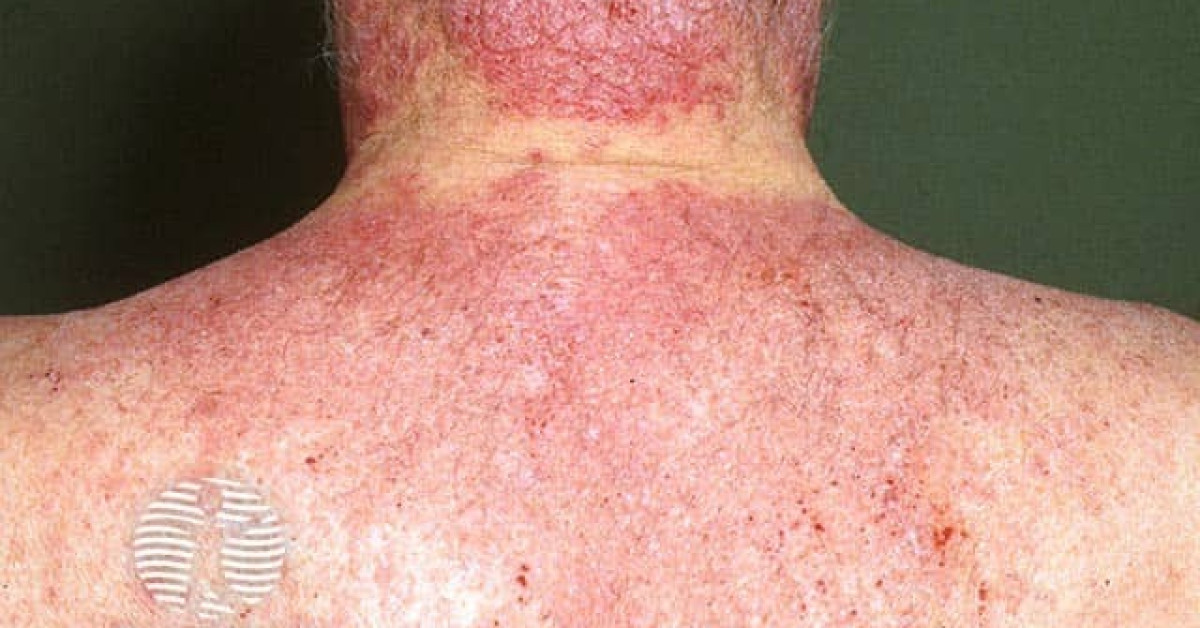 Chronic actinic dermatitis image