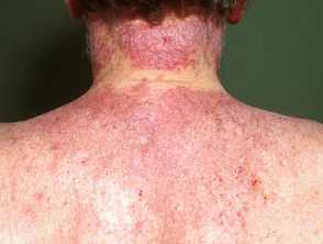Chronic actinic dermatitis