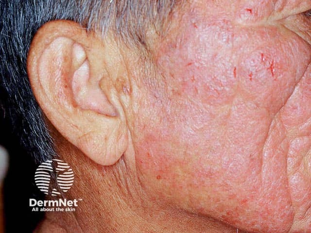 Chronic actinic dermatitis - thickened eczema with sparing in the relatively photoprotected area behind and under the ear