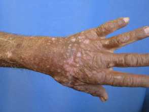 Chronic actinic dermatitis