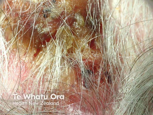 Severe chronic actinic dermatitis on the bald occipital scalp