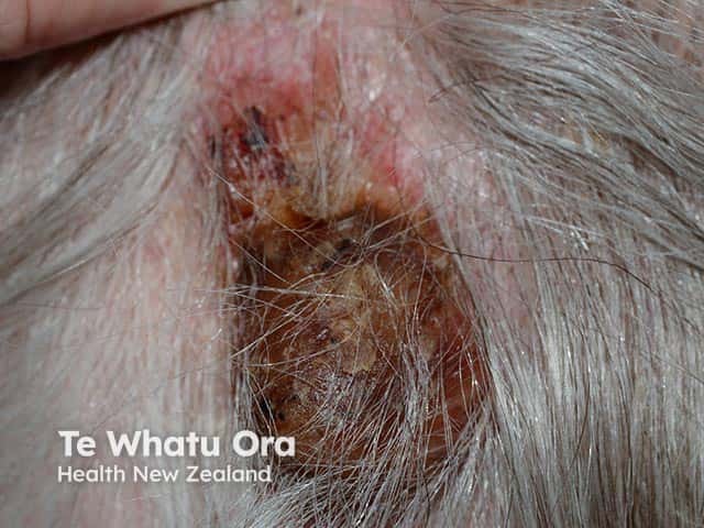 Severe chronic actinic dermatitis on the bald occipital scalp