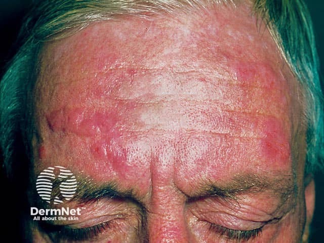 Patches and plaques of eczema on the forehead due to chronic actinic dermatitis