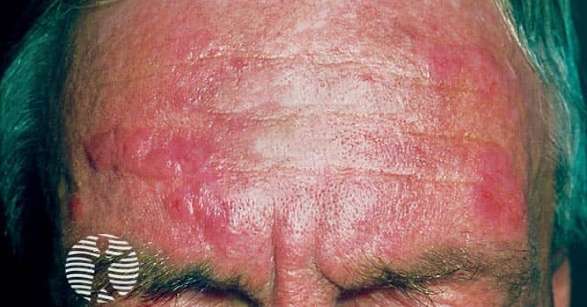 Chronic actinic dermatitis image