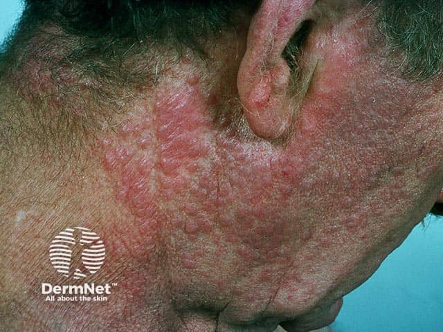 Papules and plaques of eczema on the neck due to chronic actinic dermatitis - note the sparing below and behind the ear