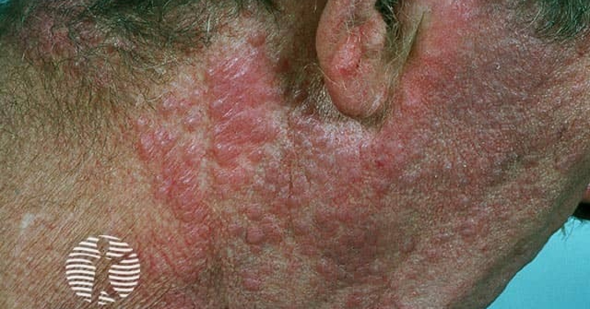 Chronic actinic dermatitis image