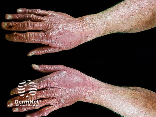 Chronic actinic dermatitis on the dorsal hands with a cut off at the wrists