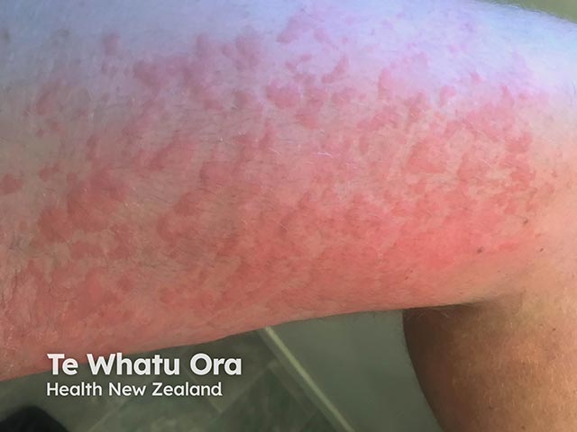 Extensive wheals on the thigh due to chronic spontaneous urticaria - they arose 2 hours ago and resolved within 12 hours