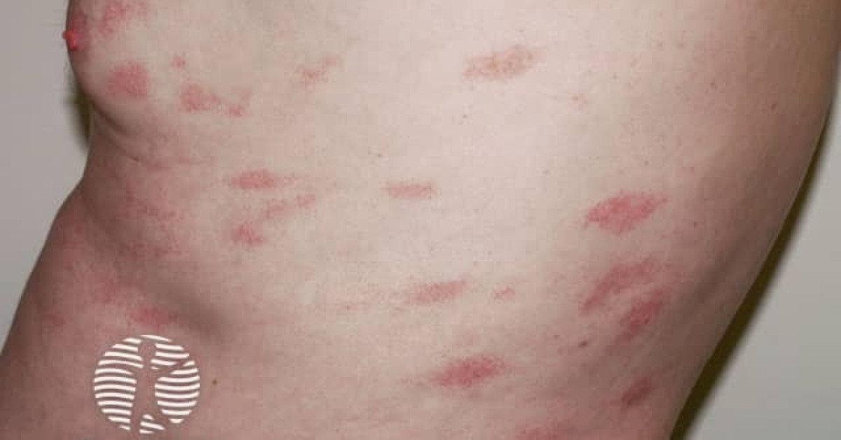 Dermnet® - Chronic Superficial Scaly Dermatitis Image