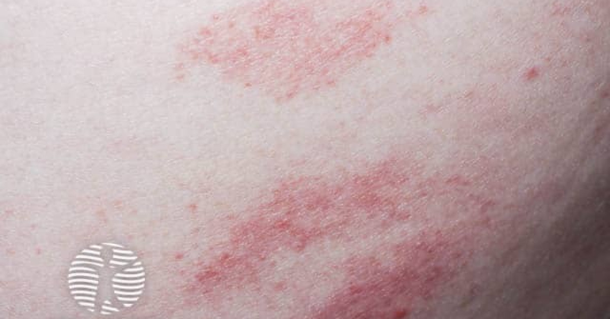 Chronic Superficial Scaly Dermatitis Image