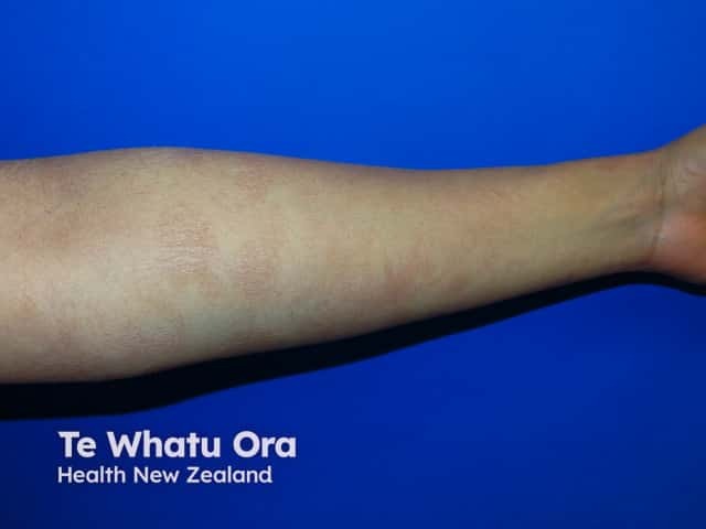 Well circumscribed fine scaly patches of CSSD on the arm