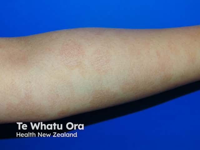 Well circumscribed fine scaly patches of CSSD on the arm