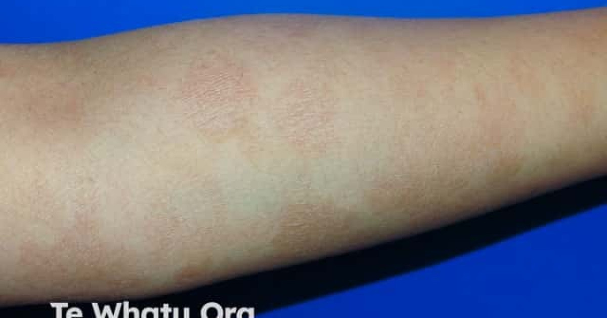 Scaliform Rash Chronic superficial scaly dermatitis image