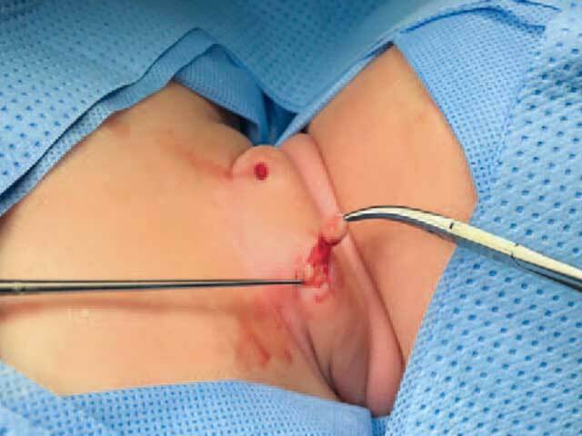 Intraoperative appearance of the chondrocutaneous remnants
