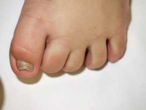 Congenital malalignment of the great toenail 