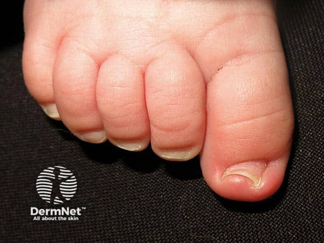 Congenital malalignment of the great toe nail in a toddler