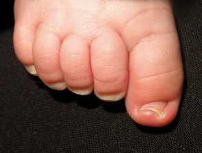 Congenital malalignment of the great toenail 