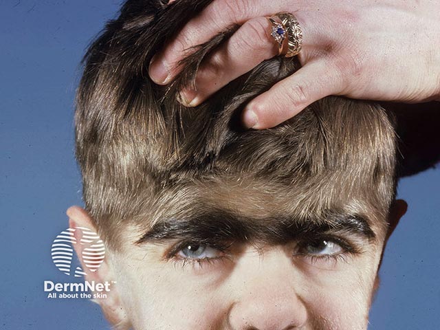 Hypertrichosis over the forehead and conjoined brows in Cornelia de Lange syndrome