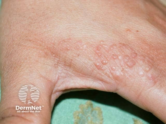 Warty papules on the hand in Cowden syndrome