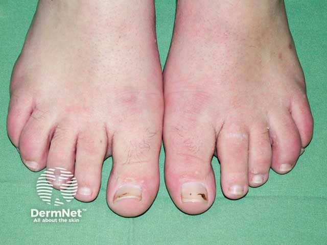 Acral papules in Cowden syndrome