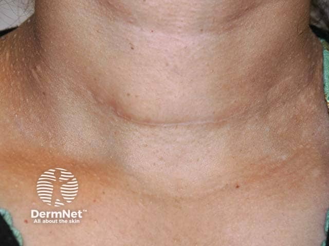 Thyroidectomy scar after thyroid cancer removal in Cowden syndrome